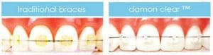 damon braces alternative